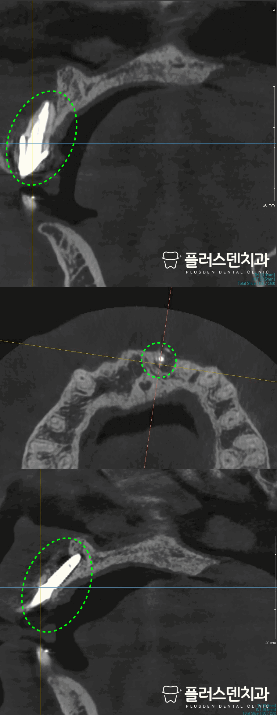 전농동 치과 플러스덴 — 재신경치료 반복 실패 원인 (부근관 세균 잔존, 치근 균열, 치근단 외 감염)