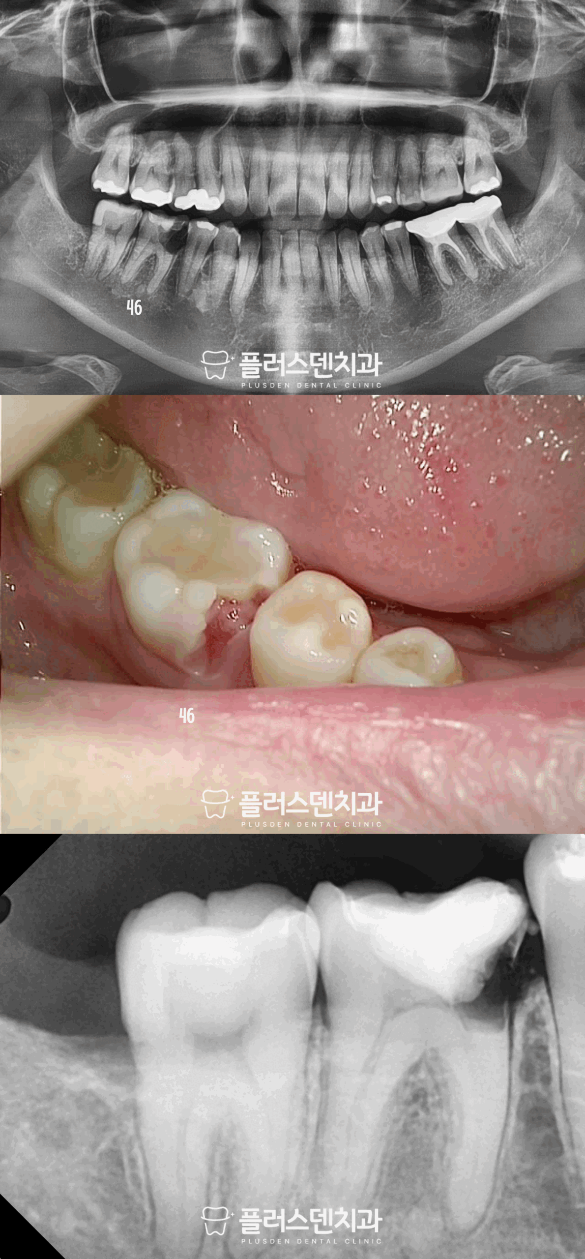 전농동 치과 플러스덴, 46번 어금니 파절 파노라마 방사선 촬영 진단