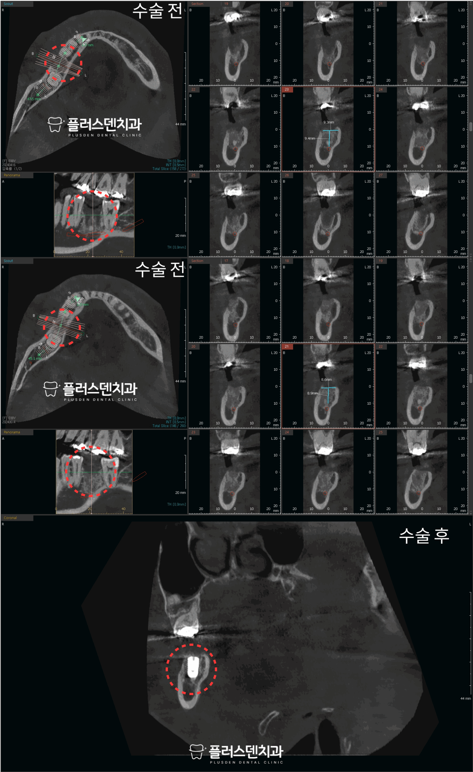 전농동 치과 플러스덴, 46번 어금니 파절 발치 및 발치와 처치