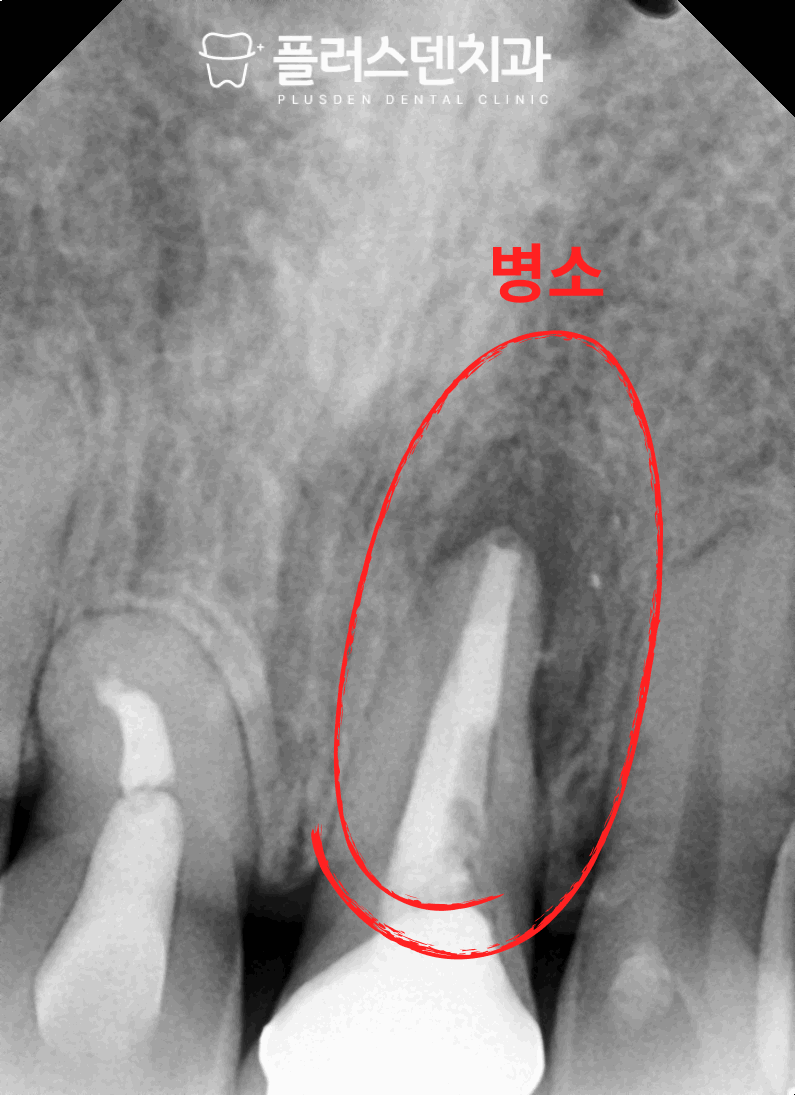 전농동 치과 플러스덴 — 임플란트 전환 시점 판단 기준 (치근 파절, 치근단 병소, 치주 골 소실)