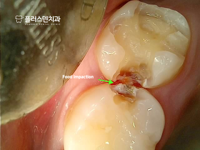 답십리치과 플러스덴 — 26번 이차우식 제거 후 사진