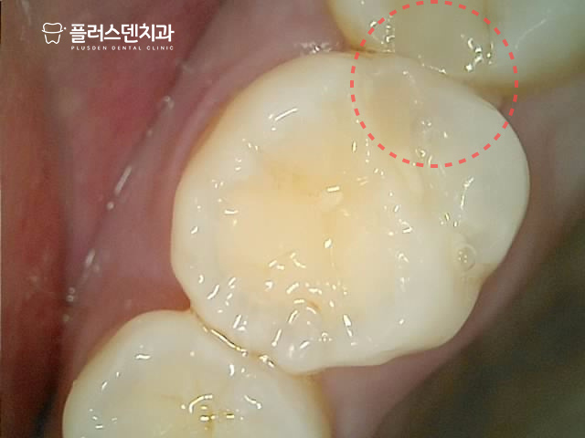 답십리치과 플러스덴 — 26번 치아 이차우식 초진 사진