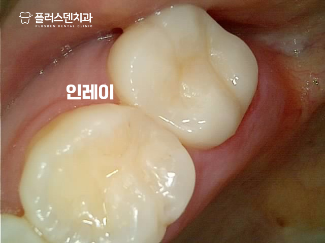 답십리치과 플러스덴 — 26번 인레이 수복 완료 사진