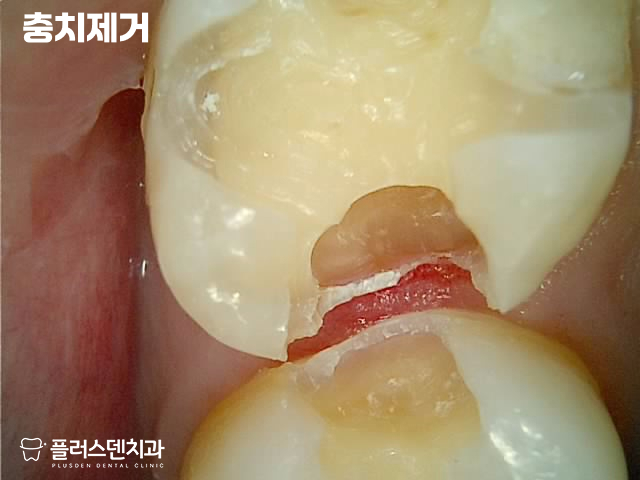 답십리치과 플러스덴 — 27번 인레이 제거 및 충치 제거 사진