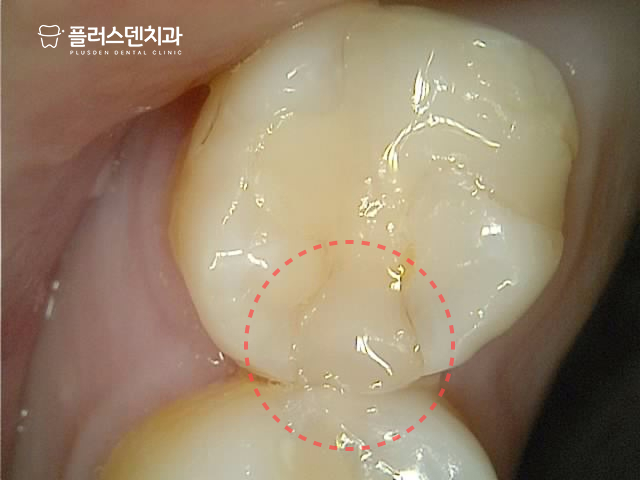 답십리치과 플러스덴 — 27번 세라믹 인레이 변연 착색 초진 사진