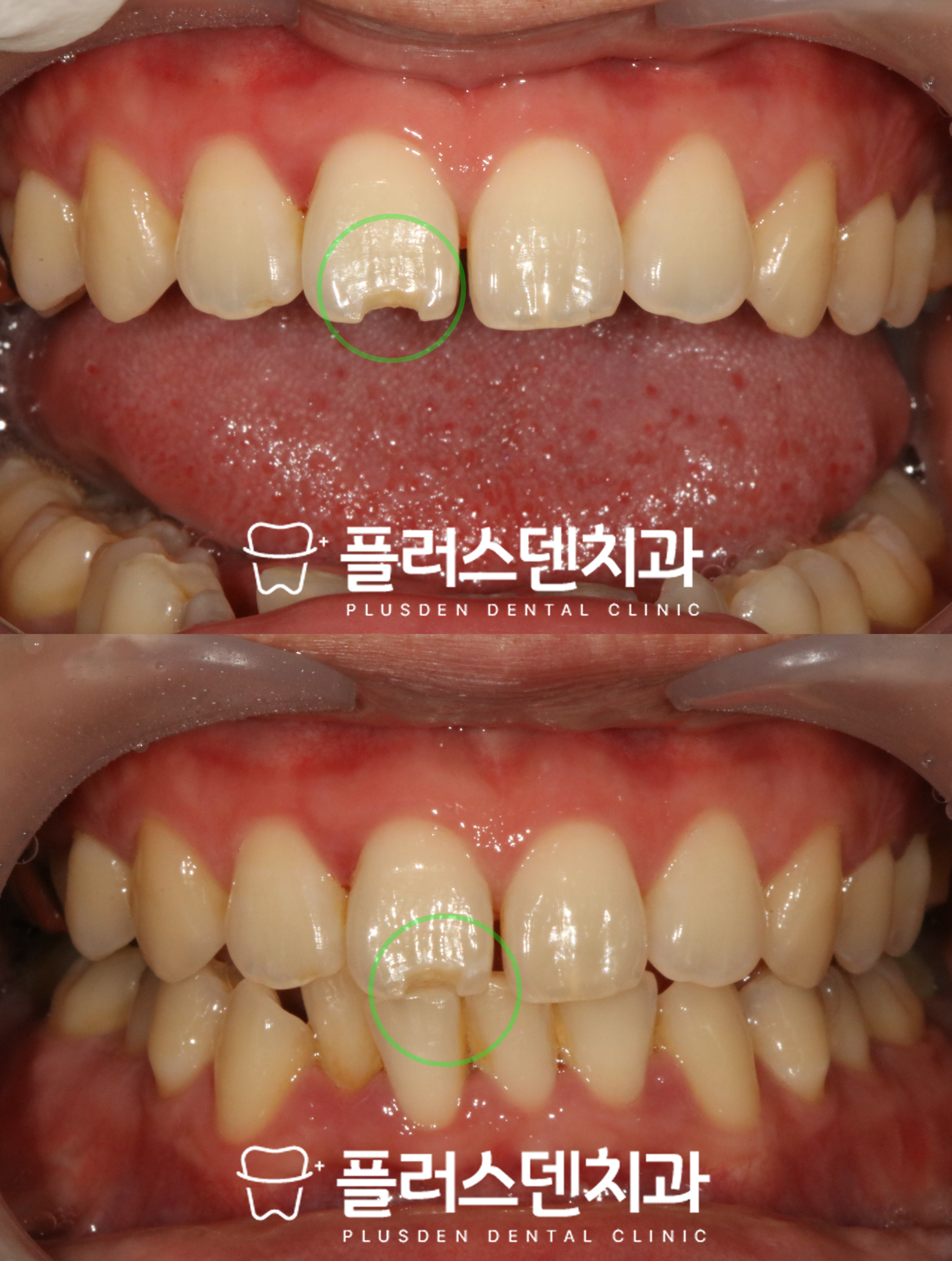 청량리 치과 플러스덴, 11번 앞니 절단연 파절 구강 내 사진 확인