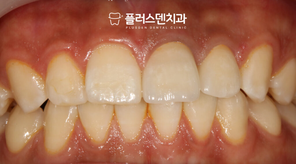 전농동치과_재보철