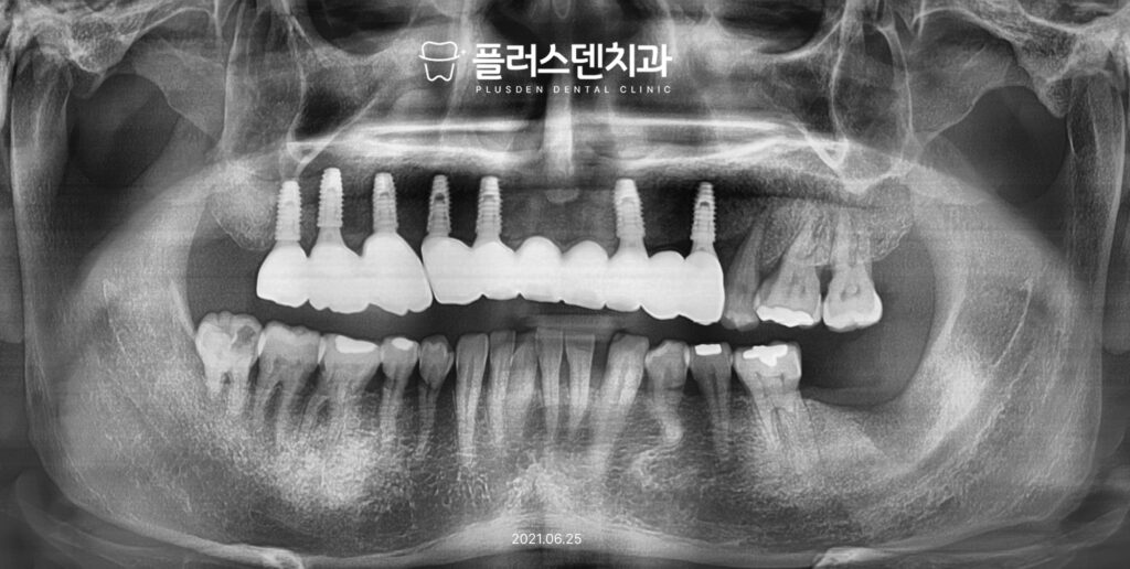 픞러스덴치과 임플란트