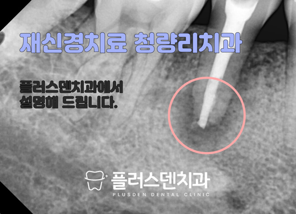 전농동치과 재신경치료